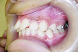 非抜歯矯正2