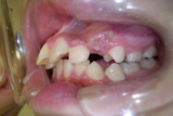 非抜歯矯正1