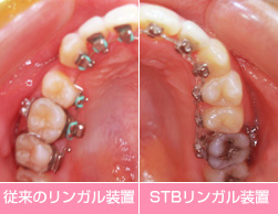 STBリンガル